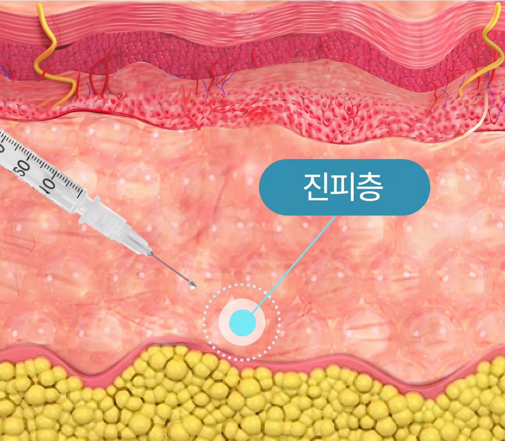 진피층에 스킨바이브 주입
